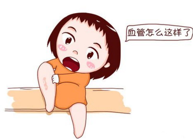 孕婦靜脈曲張是怎么回事 孕婦靜脈曲張怎么緩解 孕婦靜脈曲張是怎么回事 孕婦靜脈曲張怎么緩解