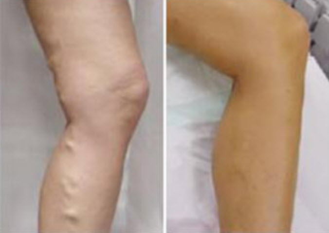 孕婦靜脈曲張是怎么回事 孕婦靜脈曲張怎么緩解 孕婦靜脈曲張是怎么回事 孕婦靜脈曲張怎么緩解