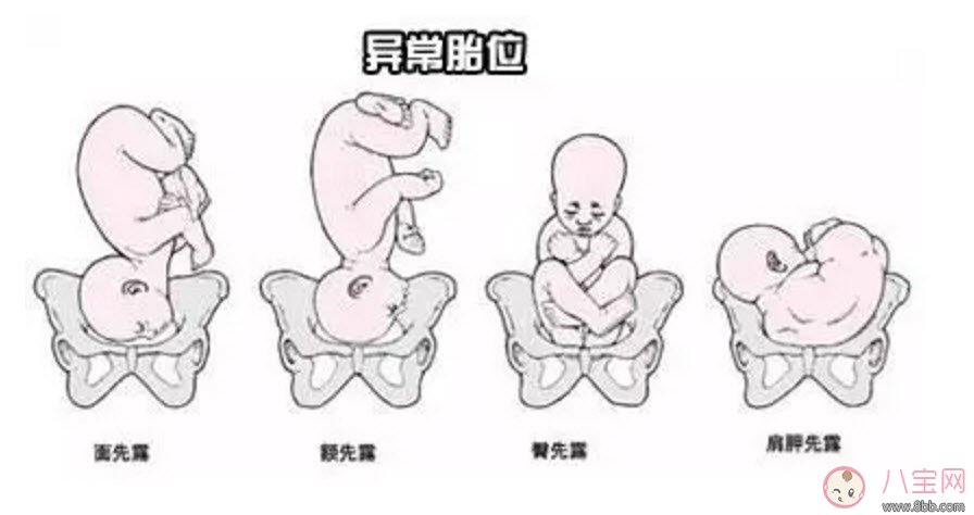 孕期胎位不正的原因 如何矯正胎位不正 孕期胎位不正的原因 如何矯正胎位不正