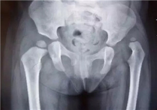 寶寶臀紋不對稱怎么回事 臀紋不對稱一定是髖關節發育不良嗎