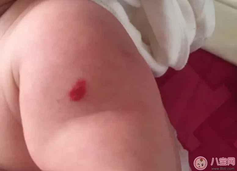 新生兒紅色胎記和血管瘤的對比方法 寶寶胎記和血管瘤的區別