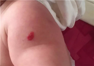 新生兒紅色胎記和血管瘤的對比方法 寶寶胎記和血管瘤的區別