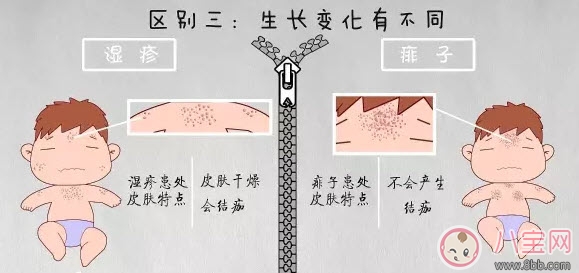 寶寶痱子和濕疹的區(qū)別 濕疹和痱子的區(qū)別圖片 寶寶痱子和濕疹的區(qū)別 濕疹和痱子的區(qū)別圖片