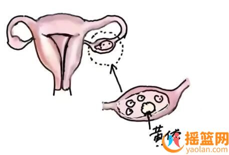 黃體破裂頻發，女性須知婦科急癥的“隱形殺手”