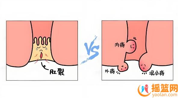 如何在不影響寶寶哺乳的情況下，解決媽媽的肛裂痔瘡問題？
