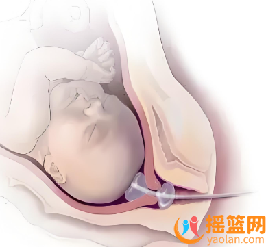 球囊止血技術助力高危孕婦轉危為安